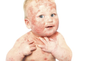 alt-eczeem-oergezond