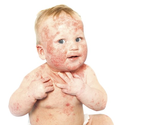 alt-eczeem-oergezond